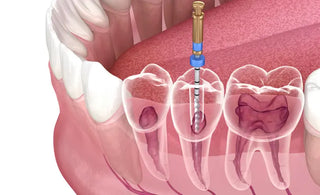 What is Root Canal Treatment?