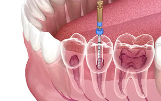 What is Root Canal Treatment?