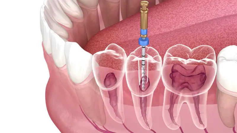 What is Root Canal Treatment?