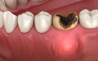 Efficacy evaluation of zirconia crown on primary molars with caries defects