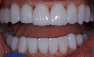 Discover the Best Option for You: Full Porcelain Veneers or Full Porcelain Crowns