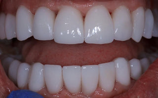 Discover the Best Option for You: Full Porcelain Veneers or Full Porcelain Crowns