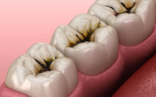 Comparing the curative effects of direct resin filling and cast porcelain high inlays on repairing defect of posterior teeth