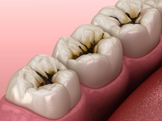 Comparing the curative effects of direct resin filling and cast porcelain high inlays on repairing defect of posterior teeth