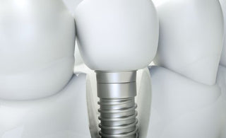 Dental Implants: Are They Safe?