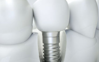 Dental Implants: Are They Safe?