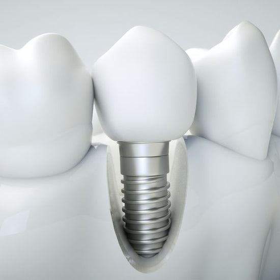 Dental Implants: Are They Safe?